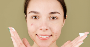 acne solutions