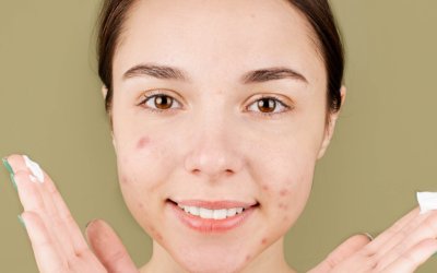 Les bons gestes anti-acné pour la rentrée